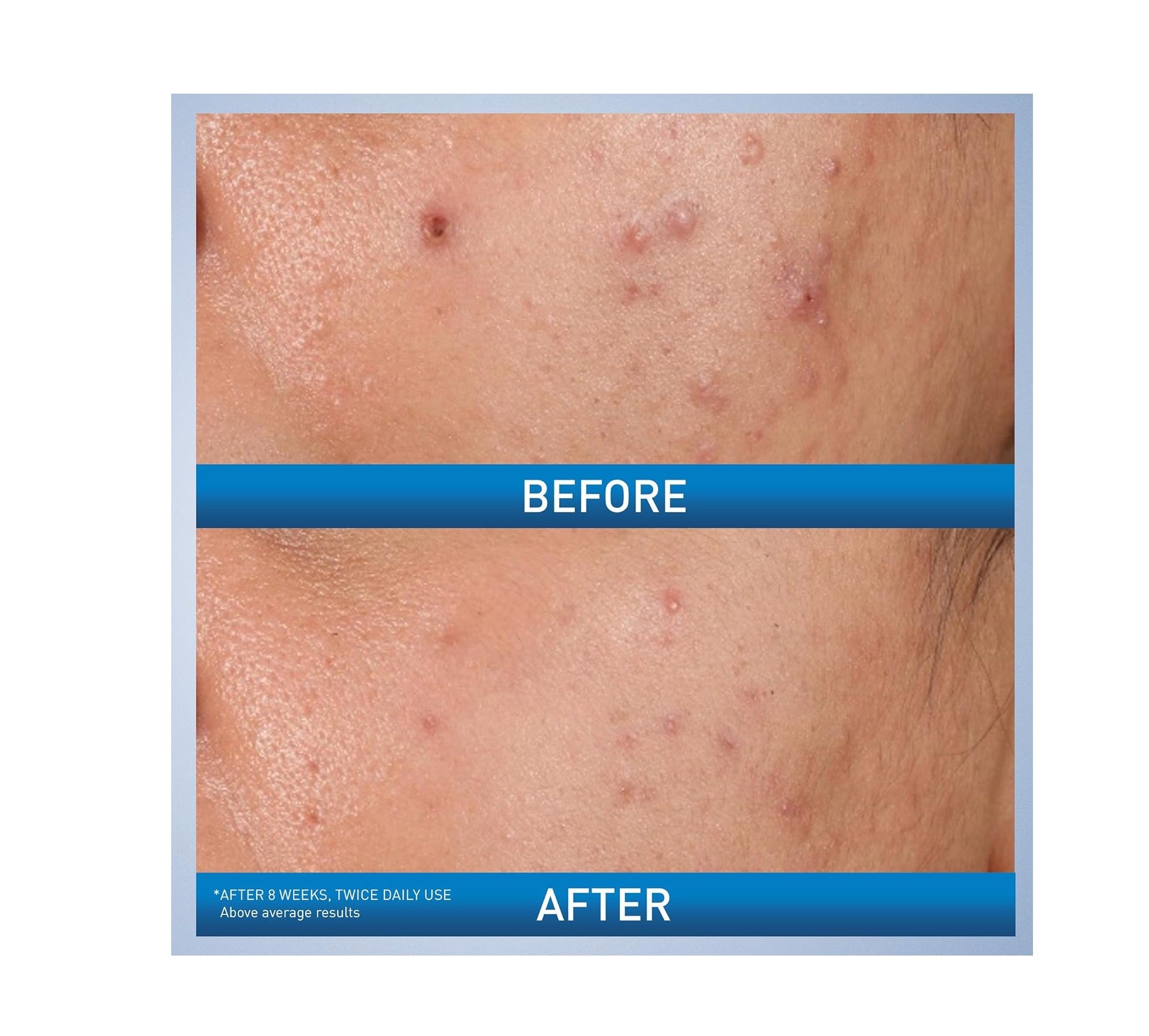 CeraVe Salicylic Acid Acne Treatment with Glycolic Acid and Lactic Acid | AHA/BHA Acne Gel for Face to Control and Clear Breakouts | Fragrance Free, Paraben Free, Oil Free & Non-Comedogenic|1.35 Ounce